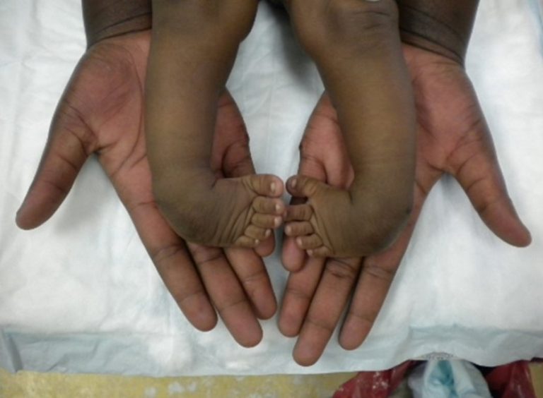Brazza Int’l Foundation organises free clubfoot treatment on March 26 & 27, 2025